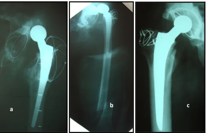 Figure 19 : Radiographies standards montrant les complications post-opératoires :  a : luxation, b : fracture fémorale et c : descellement