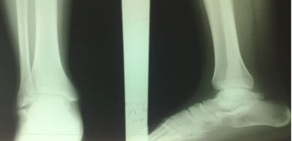Figure 9 : Radiographie Standard de la cheville 