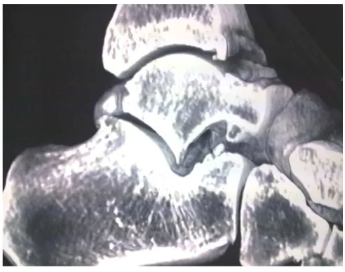 Figure   11 : Tomodensitométrie : ostéophytes tibio-taliens 