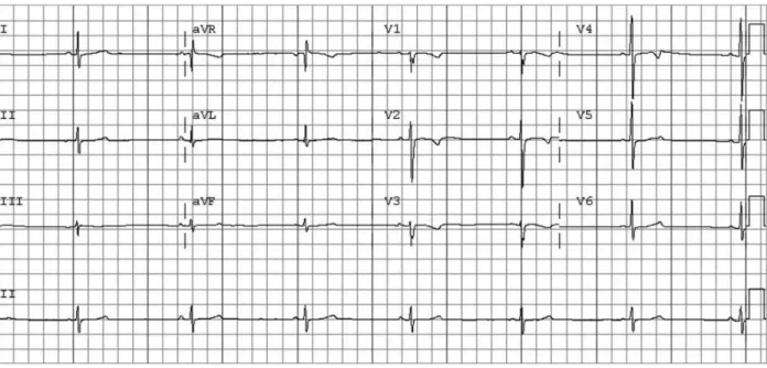 Figure 10 : ECG montrant une bradycardie avec une FC à 40 bpm, trois critères  doivent être remplis pour être classé comme rythme sinusal : (1) il doit y avoir une 