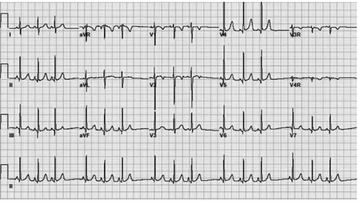 Figure 11 : ECG montrant l’arythmie sinusale, notant la variation de la fréquence  cardiaque avec la respiration
