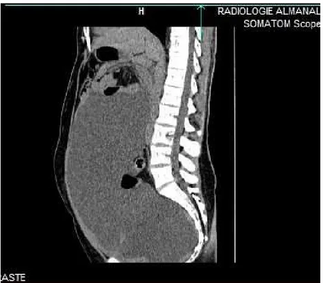 Figure 2 : Coupe sagittale du scanner abdominal montrant une ascite abondante 
