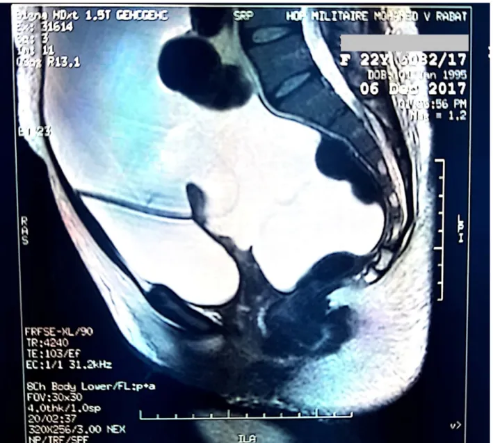 Figure  4  :  L'IRM  abdominale  en  coupe  horizontale  montrant  une  ascite  de  grande  abondance