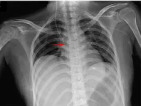 Figure  5  :  Radiographie  thoracique  de  contrôle  montrant  le  drain  au  niveau  de  l’oreillette droite