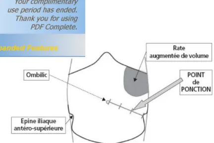 Figure  12.  Repères  du  site  de  ponction  d’ascite  chez  le  sujet  en  décubitus  dorsal  :   en pleine matité, à la jonction du tiers externe et du tiers moyen de la ligne  joignant épine iliaque antéro-supérieure et ombilic