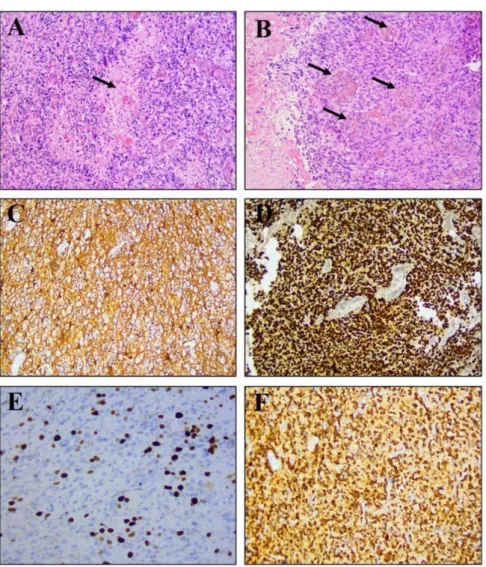 Figure 7. Images histologiques A] d’un foyer nécrotique et B] de la prolifération endothélio-capillaire par  HES, et de marquages immuno-histochimiques C] d’Olig2, D] de GFAP, E] de Ki-67 et F] de la mutation 