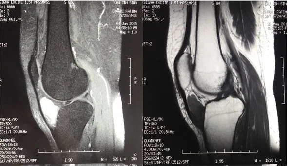 Figure 5 : IRM du genou droit, coupes sagittales montrant la lésion infra-patellaire, en  hyposignal T1 (à droite) et hypersignal T2 (à gauche)