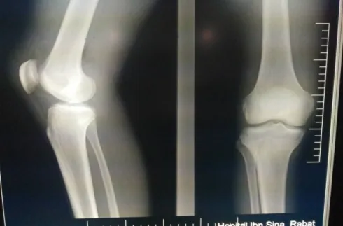 Figure 6 : Radiographie standard du genou droit, face et profil, ne montrant aucune  anomalie
