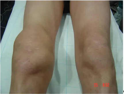 Figure 17 : Tuméfaction du genou droit chez un patient atteint de SVN. [114] 