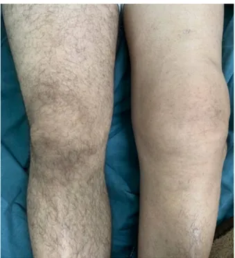 Figure 18 : Tuméfaction du genou gauche chez un patient atteint de SVN, avec à  l'examen physique un signe de choc rotulien qui est positif
