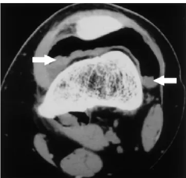 Figure 24 : TDM du genou, coupe axiale : Epaississement synovial nodulaire et  irrégulier dans la région rétropatellaire