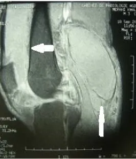 Figure 27 : Vue IRM d'une synovite villonodulaire du cul de sac sous quadricipital et du  creux poplité du genou droit