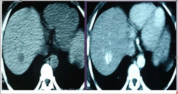 Figure 4 :MH (image hypodense en C- à gauche) rehaussée en temps artériel. 