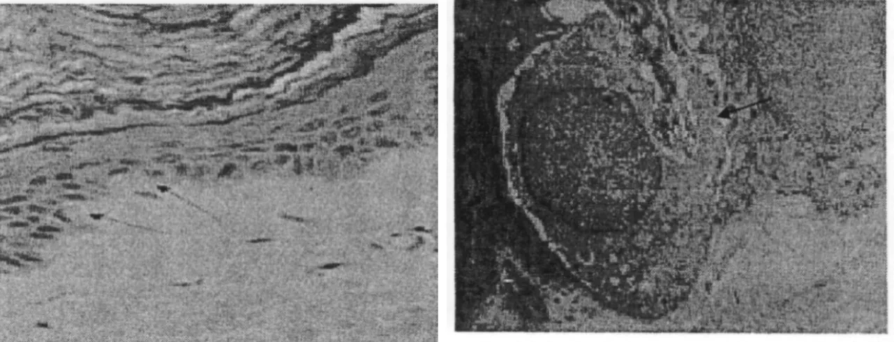 Figure 9 : Mélanocytes dans l'assise Figure 10 ; ME centrée sur un basale [12]  
