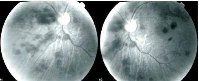 Figure 6: FO avec angiographie à la fluorescéine mettant en évidence desdilatations veineuses,  nombreuses avec deshémorragies rétiniennes 