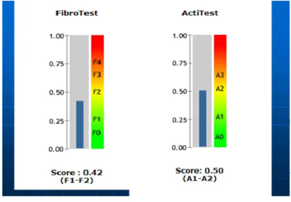 Graphique n° 6: exemple de fibrotest réalisé chez un patient   atteintd’hépatite virale B chronique 