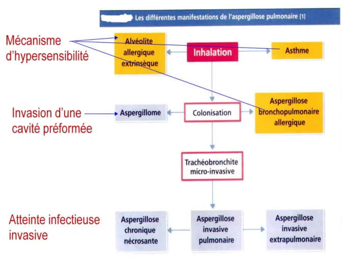 Figure 3 : Différentes formes cliniques des aspergilloses  bronchopulmonaires [1] 