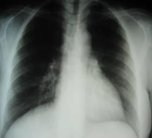 Figure 5 : Élargissement médiastinale à la radiographie pulmonaire. 