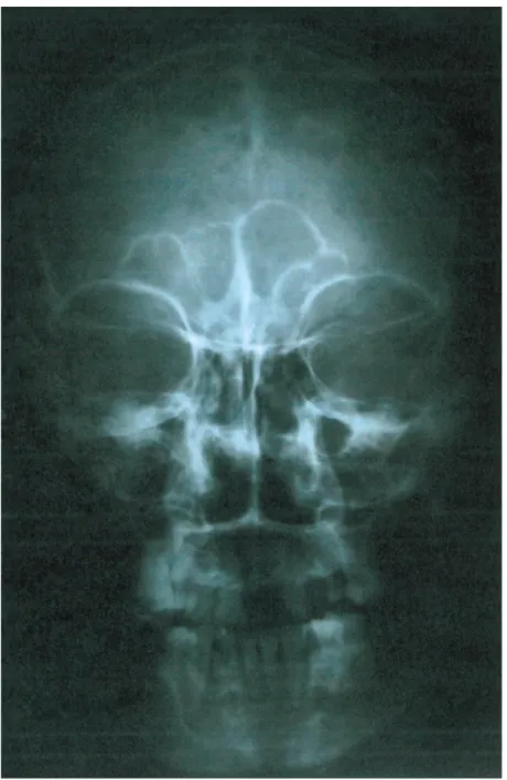 Figure 2 : Radiographie du crâne de face montrant des images lytiques à l’emporte pièce