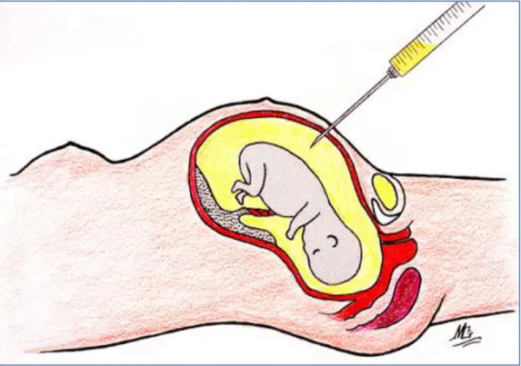 Figure 8: Technique d’amniocentèse . [63] 