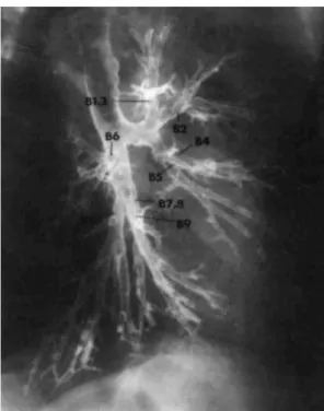 Figure 1-18 bronchographie de l'arbre bronchique gauche (cliché emprunté à [27 - Grenier 1996]).