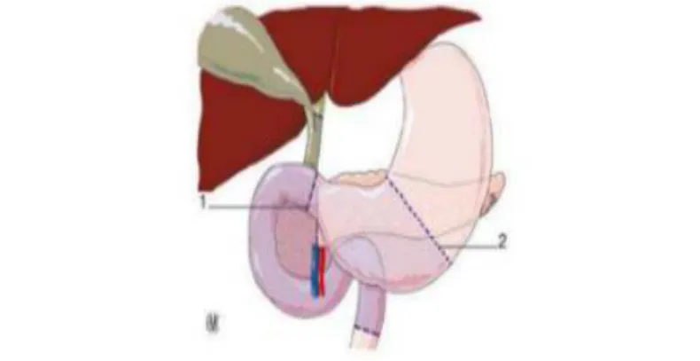 Figure 1 : duodenopancreatectomie cephalique:limite de resection en cas de conservation  antropylorique(1) et en cas d’antrectomie (4) 