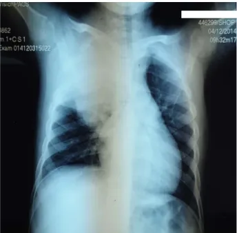 Figure 11 : Radio du thorax de face montrant un opacité apicale droite.,   Archives du CHOP