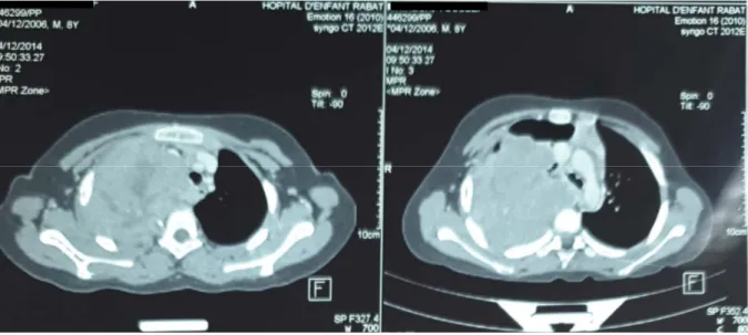 Figure 13  : images scanographiques montrant une masse médiastinale   postérieure.Archives du CHOP