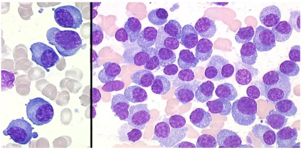 Figure 2 : Plasmocytes matures au cours du myélome multiple.  