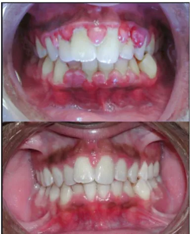Figure 6: Gingivite ulcéronécrosante  [17].