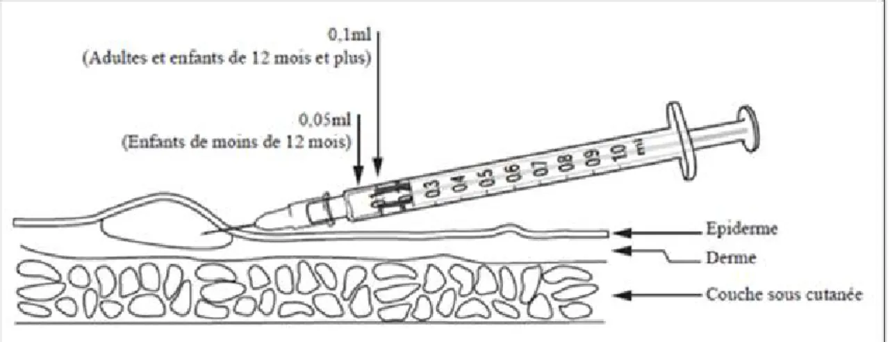 Figure 10 : Schéma de l’injection intradermique du vaccin BCG [38] 