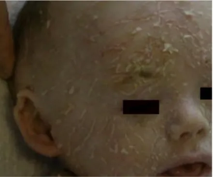 Figure 7 : Déformation du pavillon des oreilles témoignant d’un état de bébé collodion à  la naissance