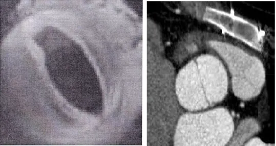 Figure 27 : Schéma de valve aortique bicuspide en TDM en systole et en diastole. 