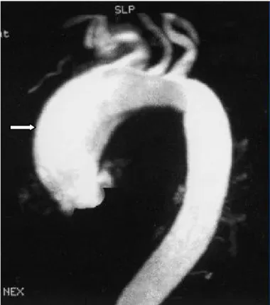 Figure 29 : image scanographique objectivant une dilatation de l’aorte ascendante  Extrait de [6] « Alan C Braverman, et al, The bicuspid aortic valve