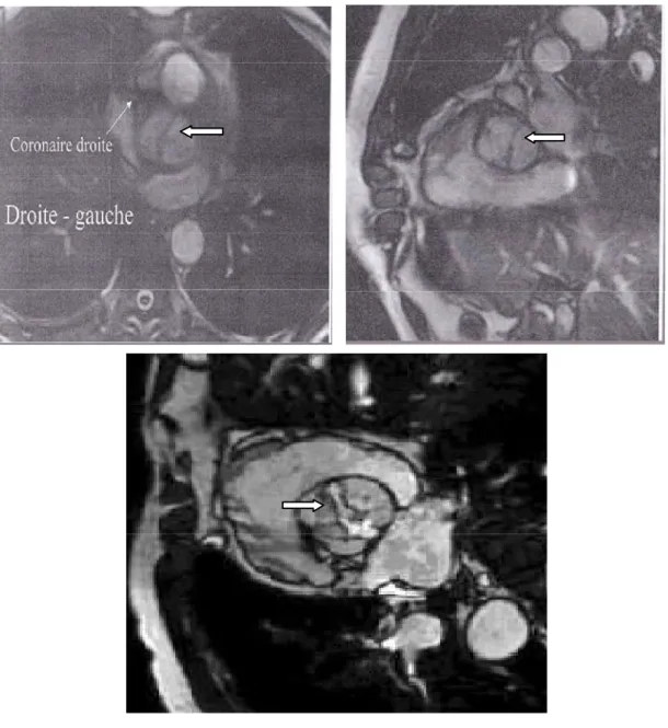 Figure 31 : Des images objectivant une BA en IRM 