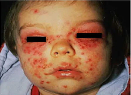 Figure 13: Primo-infection herpétique chez un nourrisson [52].