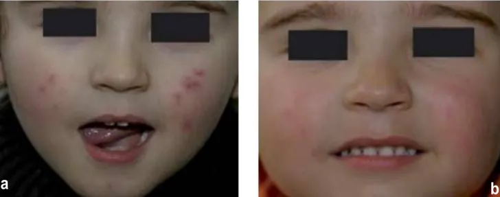 Figure 31: Rosacée chez un enfant de 7 ans, en phase papulopustuleuse (a) et en phase  érythémato-télangiectasique après traitement par métronidazole topique (b)