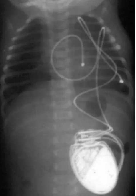 Figure n 3 : Radiographique thoracique d’un nouveau