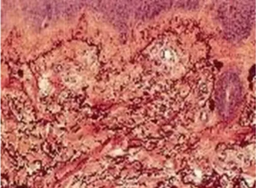 Figure 10 : Coupe histologique du réseau élastique du derme superficiel nose cutanée chez l’enfant : étiopathogénie et formes cliniques