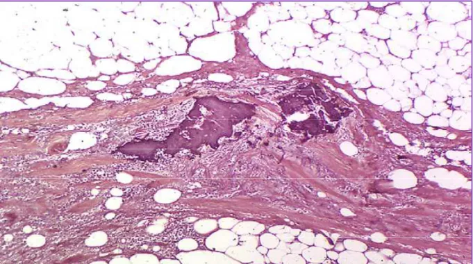 Figure 29 : Dépôts calciques cutanés consistant en des masses acellulaires bleues-  violettes de forme irrégulière dans le derme profond (HES)