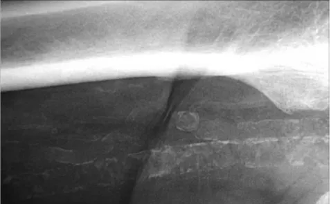 Figure 12 - Calcifications diffuses de la jambe [15]. 