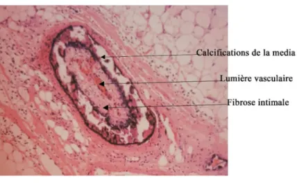 Figure 14 : Aspects histopathologies dans l’ACU (colorations HES et Von Kossa) : artériole  avec dépôts calciques dans la média, hyperplasie de l’intima et thrombose et un dépôt 