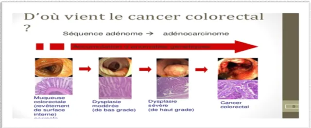 Figure 9 : Séquence adénome cancer 