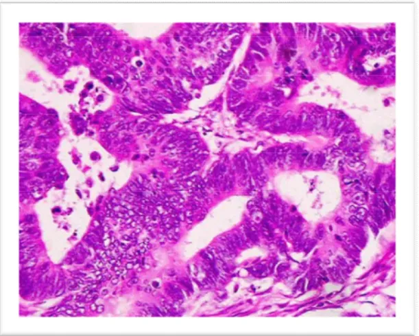 Figure 11: aspect microscopique d'un ADK bien différencié   d’après le service d’anatomopathologie d’Avicenne Rabat 