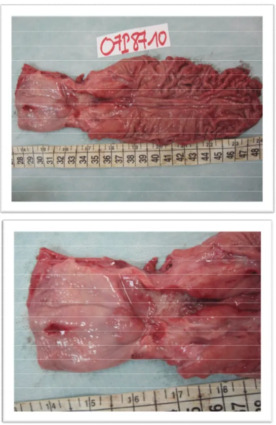 Figure 14 : aspect macroscopique d'un ADK peu différencié   d'après le service d'anatomopathologie d'Avicenne Rabat 