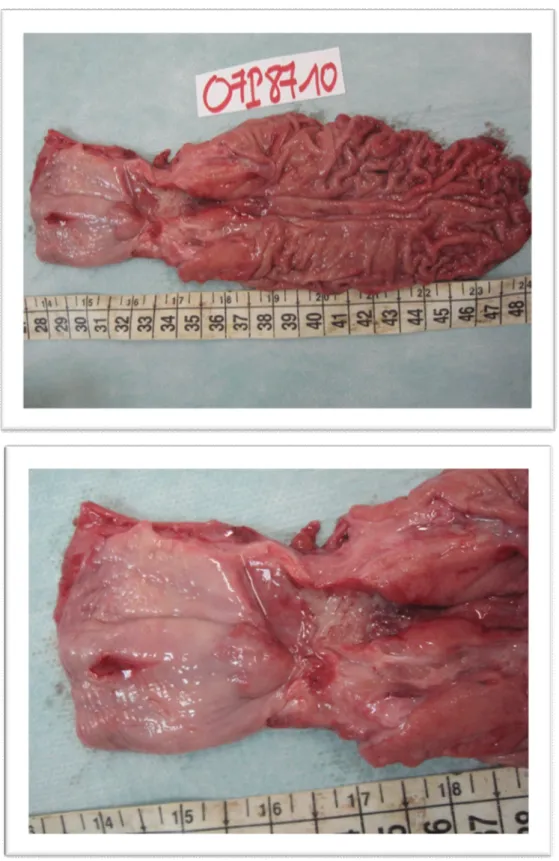 Figure 14 : aspect macroscopique d'un ADK peu différencié   d'après le service d'anatomopathologie d'Avicenne Rabat 