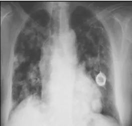 Figure 3 : Radiologie du thorax montrant une image en lâcher de ballon   chez un patient de notre étude