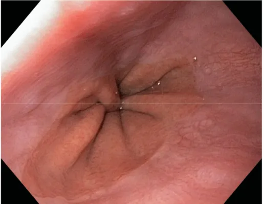 Figure 6 : Vue endoscopique de la zone jonctionnelle entre la muqueuse   œsophagienne et gastrique 