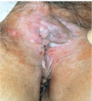 Figure 6 : Lichen scléreux vulvaire hypertrophique  [9].
