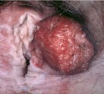 Figure 12 :Tumeur bourgeonnante vulvaire : carcinome épidermoîde [ 10 ] . 